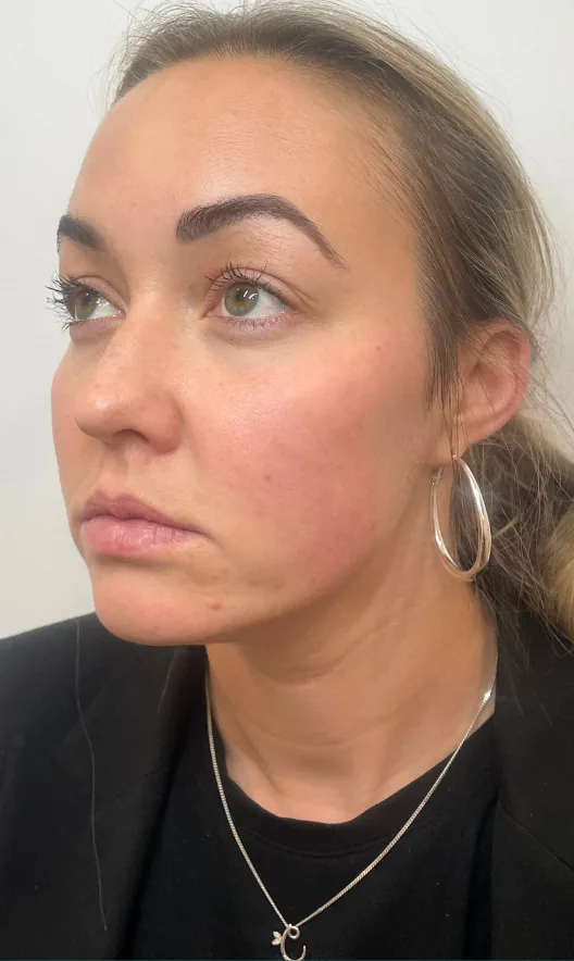 Before dermal filler, lips, cheeks and chin