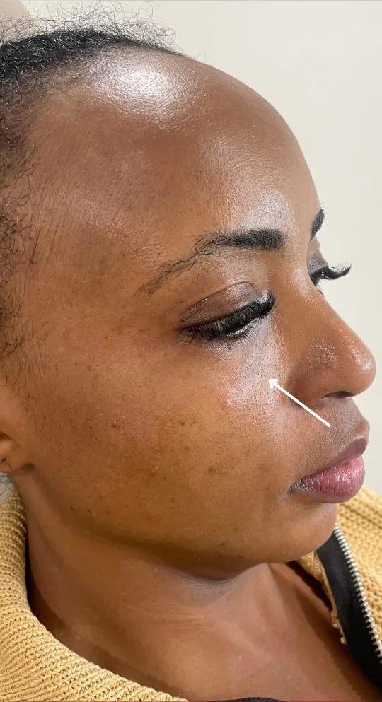 After dermal filler, tear trough