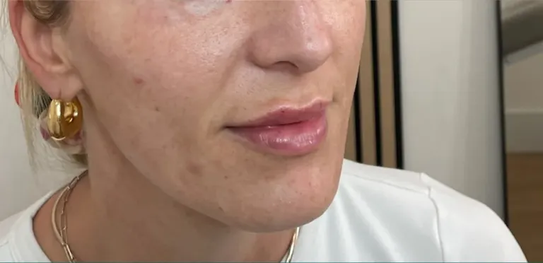 After lip filler, lips