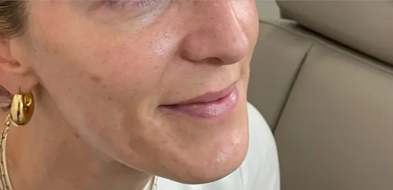 Before lip filler, lips