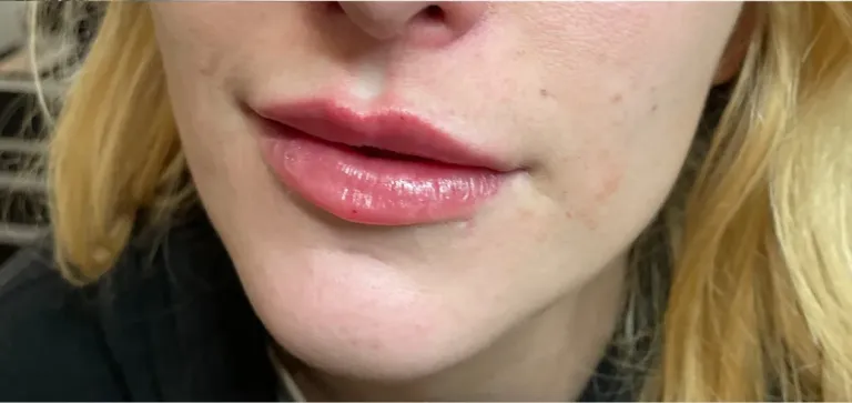 After lip filler, lips