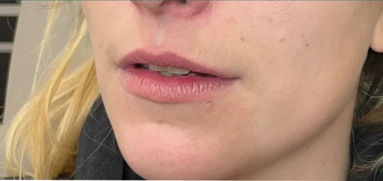 Before lip filler, lips