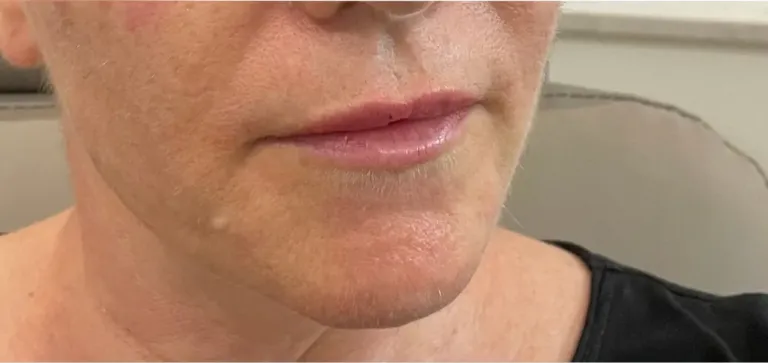 After lip filler, lips