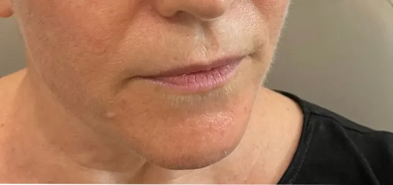 Before lip filler, lips