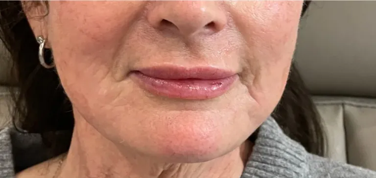 After lip filler, lips