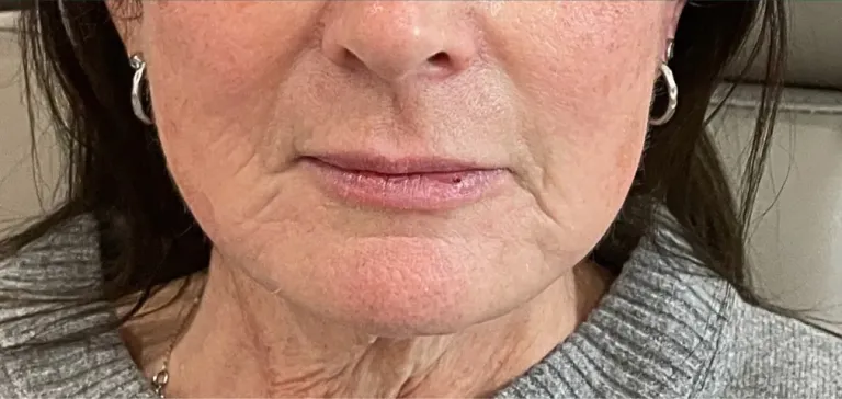 Before lip filler, lips