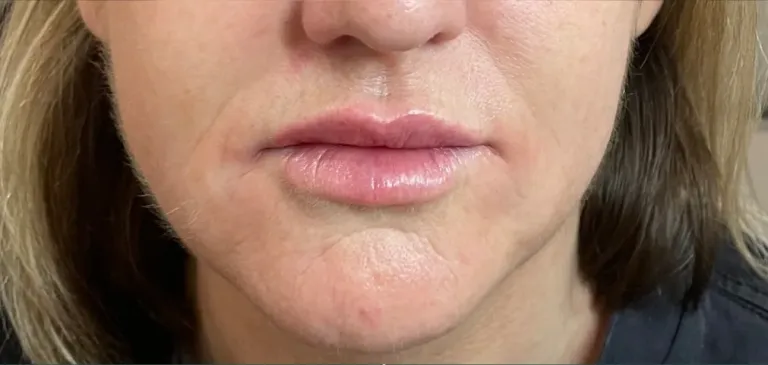 After lip filler, lips