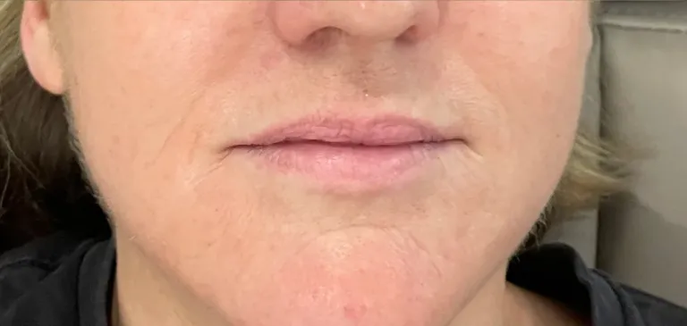 Before lip filler, lips