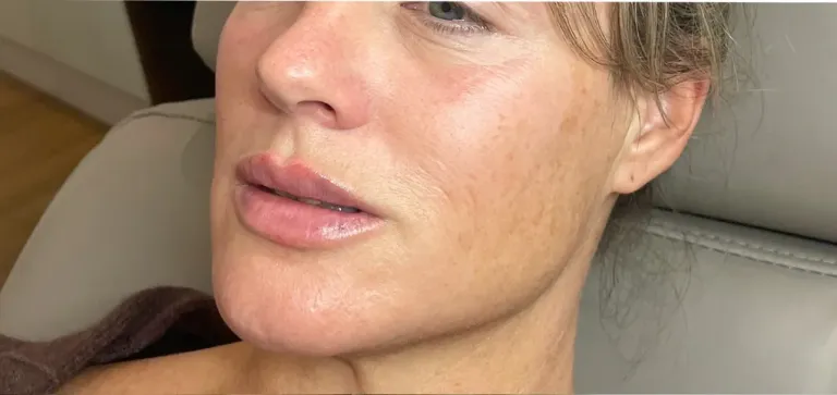 After lip filler, lips