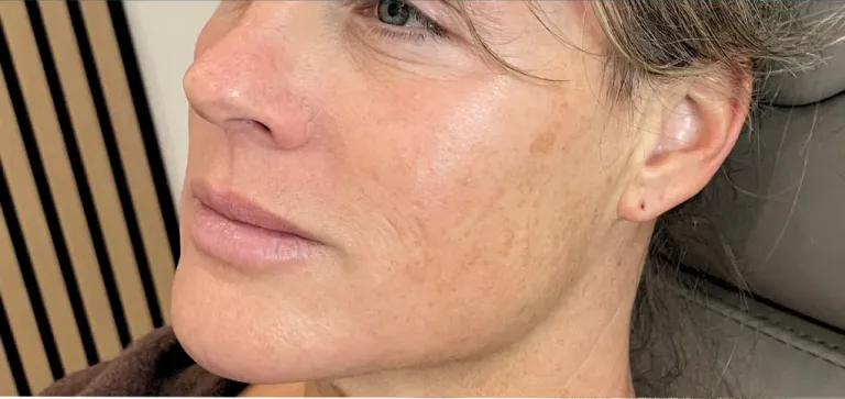 Before lip filler, lips