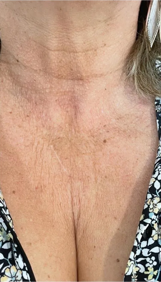 After polynucleotides, chest