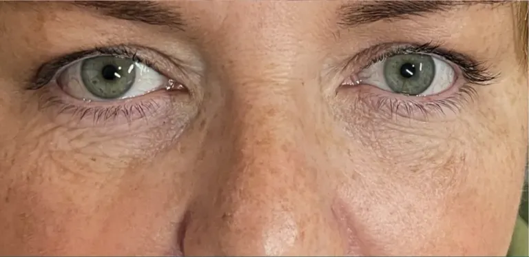 After polynucleotides, under eyes