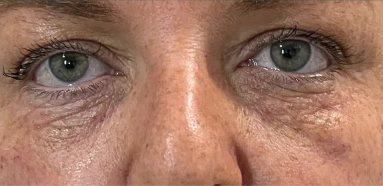 Before polynucleotides, under eyes