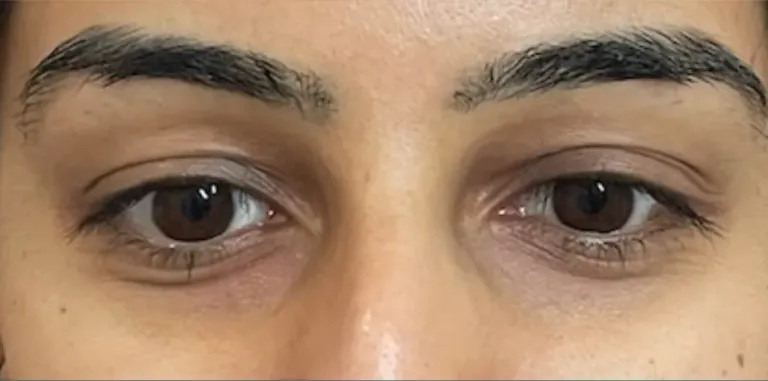 After polynucleotides, under eyes