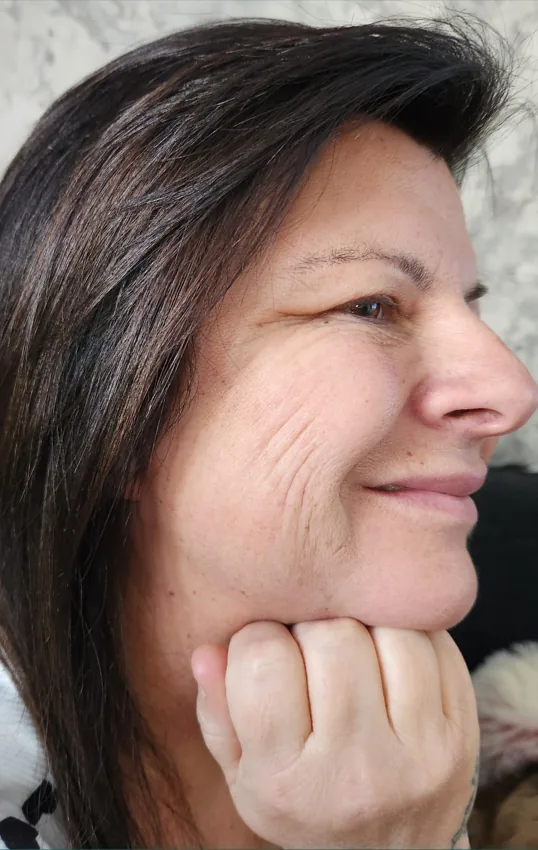 After skin boosters & profhilo, profhilo