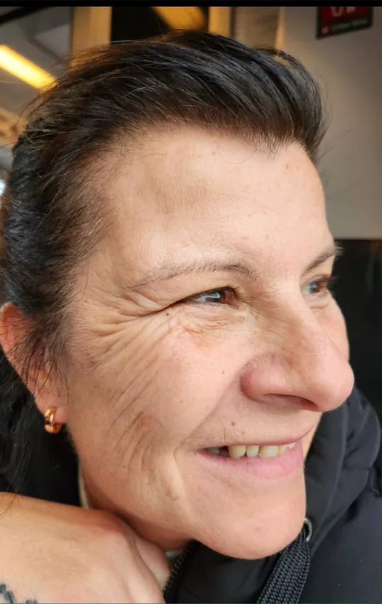 Before skin boosters & profhilo, profhilo