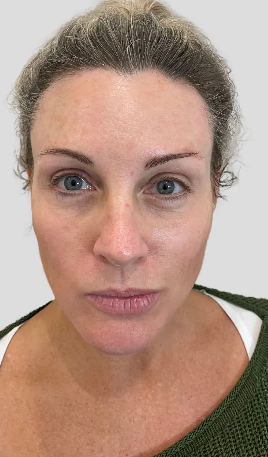 After skin boosters & profhilo, profhilo structura