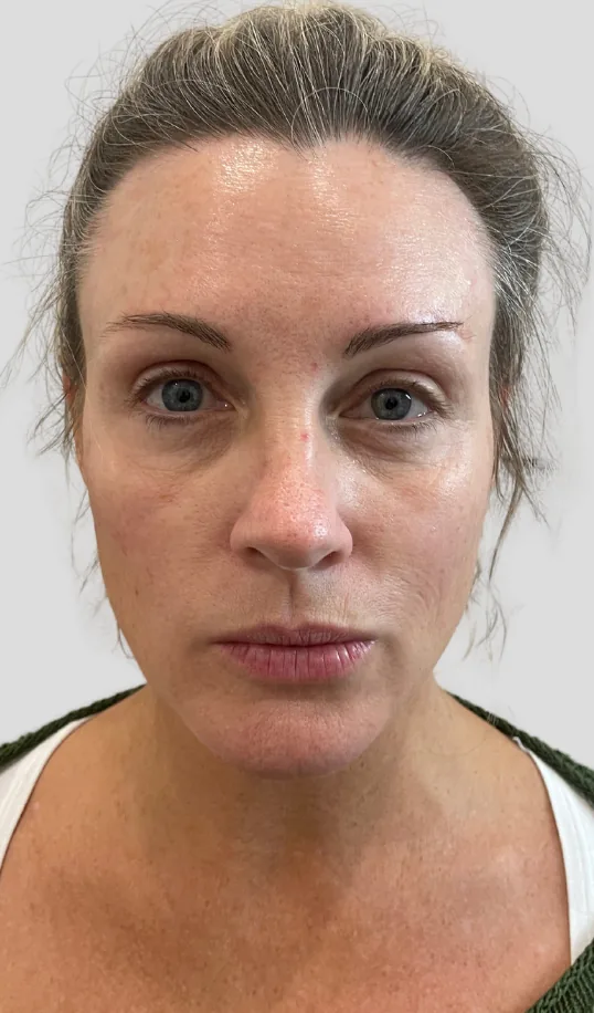 Before skin boosters & profhilo, profhilo structura